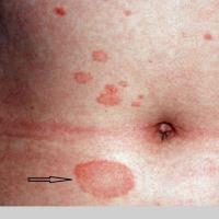 Pityriasis rosea&nbsp;
Herald Patch (arrow)