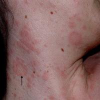 
	Pityriasis rosea 
	
	Fine scale at the…