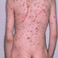 
	Secondary syphilis
	
	Copied with kind…