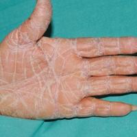 
	Pityriasis rubra pilaris&nbsp;

	Palmoplantar…
