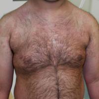 
	Pityriasis versicolor