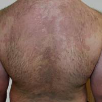 
	Pityriasis versicolor
	
	Same patient as…