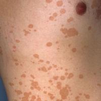 
	Pityriasis versicolor&nbsp;
