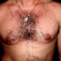
	Pityriasis versicolor
	
	Copied with kind…