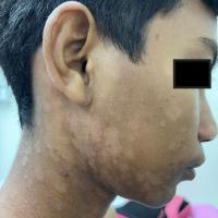 Pityriasis versicolor 
Copied with kind…