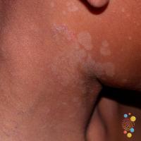 Pityriasis versicolor&nbsp;
Copied with kind…