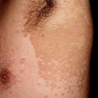 
	Pityriasis versicolor

	Oval lesions, confluent…