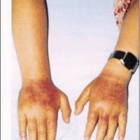 
	Erythropoietic&nbsp;protoporphyria