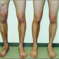 
	Klippel-Trenaunay syndrome and unaffected…