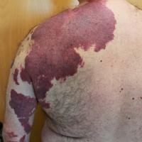 Port-wine stain&nbsp;
Extensive - referral…