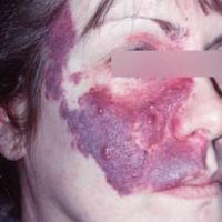 Port-wine stain as part of the Sturge-Weber…