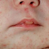 
	Neonatal acne