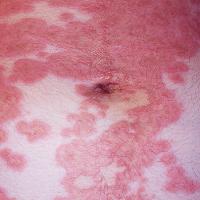 
	Pemphigoid gestationis

	Copied with kind…