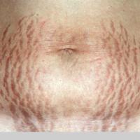 Striae gravidum