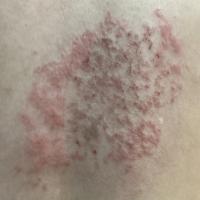 Prurigo pigmentosa
Reticular pattern…