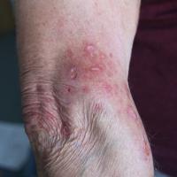 
	Brachioradial pruritus

	The itching and…