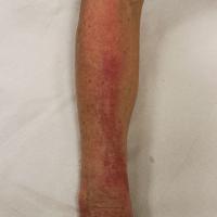 
	Brachioradial pruritus

	The itch was severe,…