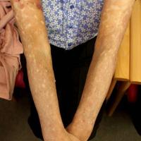 
	Pruritus - severe

	This elderly woman…