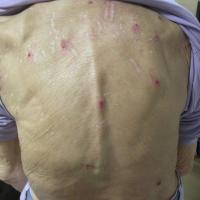 
	Pruritus with excoriations and scars

	This…