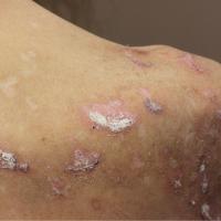 
	Delusions of parasitosis

	Excoriations caused…