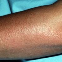 
	Asteatotic eczema