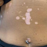 Chronic plaque psoriasis and sunbeds
This…