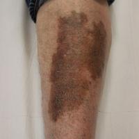
	Post dithranol&nbsp;

	This image was taken six…