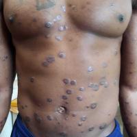 Chronic plaque psoriasis after one month of…
