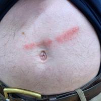 Psoriasis and Koebner phenomenon
The Koebner…
