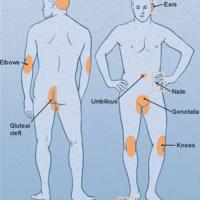 Common sites for psoriasis