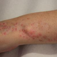 Psoriasis growing in the lines of&nbsp;Blaschko
