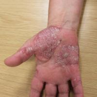 
	Psoriasis of hand: close-up