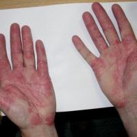 
	Same patient as figure 19