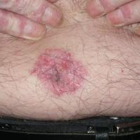 
	Psoriasis affecting the umbilicus 