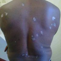 
	Large plaque psoriasis in skin of colour