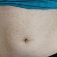 
	Small plaque psoriasis&nbsp;