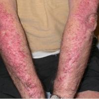 
	Large plaque psoriasis

	Large and confluent…