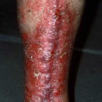 
	Large plaque psoriasis on the legs

	Large and…