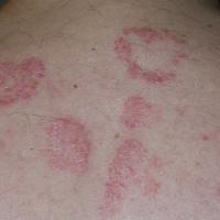 
	Large plaque psoriasis
	
	These plaques were…