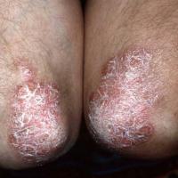 
	Large plaque psoriasis on the elbows

	&nbsp;