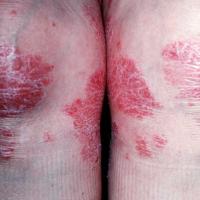 
	Large plaque psoriasis on the knees

	&nbsp;
