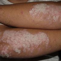 
	Large plaque psoriasis on the forearms