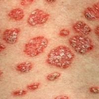 
	Large plaque psoriasis close-up
