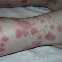 
	Large plaque psoriasis