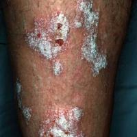 
	Large plaque psoriasis with very thick…
