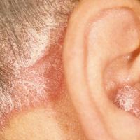 
	Psoriasis of the scalp and concha of the ear
