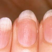 
	Nail psoriasis

	Pitting and onycholysis