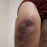 Psoriasis&nbsp;
Copied with kind permission from…