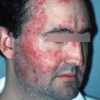 
	Facial psoriasis 