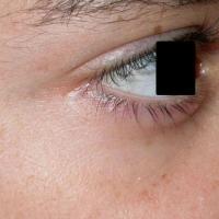 
	Same patient as figure 3 - treated with…